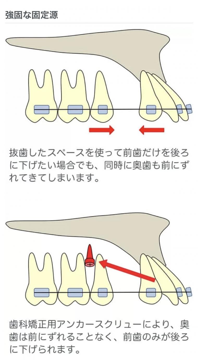 インプラント矯正ってご存知ですか?