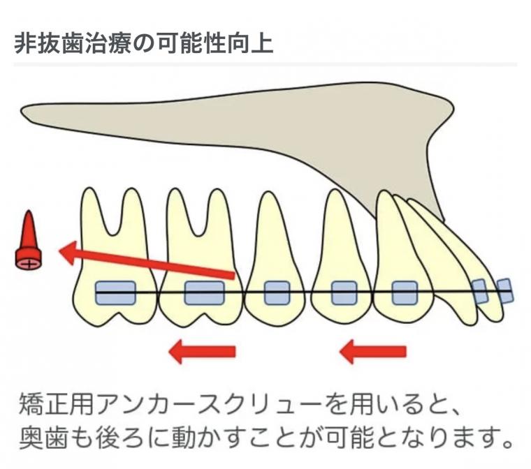 インプラント矯正ってご存知ですか?